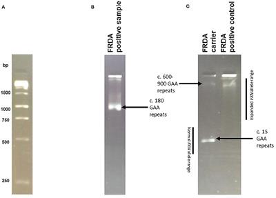 Friedreich's Ataxia Frequency in a Large Cohort of Genetically Undetermined Ataxia Patients